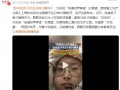 00后女子天生只有10颗牙 18岁才被确诊“无后牙”!