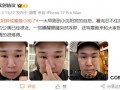 笑不活了!小沈阳一觉睡醒眼睛肿成蜜蜂小狗,又好笑又心疼!